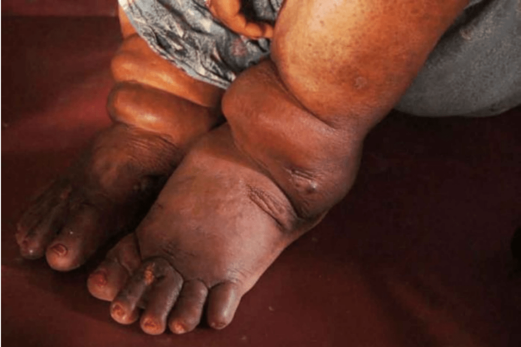 The feet of a patient with lymphatic filariasis